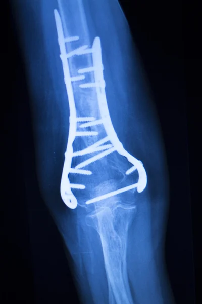 Implante cirúrgico braço cotovelo raio X varredura de teste — Fotografia de Stock