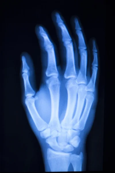 Сканування рентгенівського пальця руки в лікарні — стокове фото