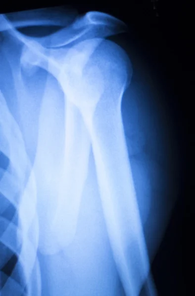 Ортопедія рентгенівського сканування травми плечей — стокове фото