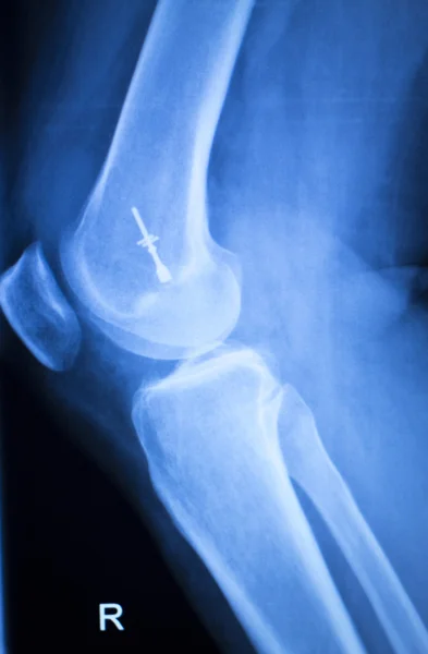 Prueba de rayos X de implante de rodilla — Foto de Stock