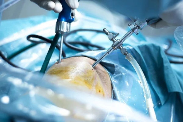 Knee arthroscopy orthopedic surgery operation