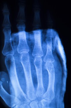 El parmak başparmak hastane xray inceden inceye gözden geçirmek