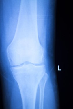 Diz eklem Menisküs x-ray sınama taraması