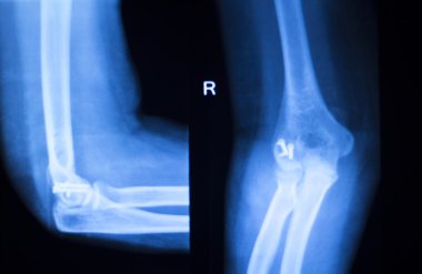 Cerrahi implant kol dirsek xray sınama taraması