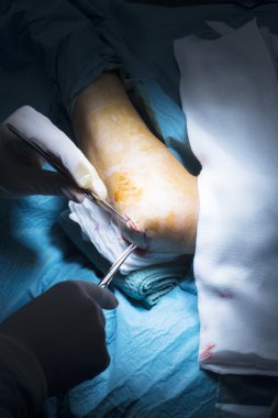 Hastane dirsek ortopedi Cerrahi operasyon