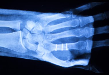 El ortopedi xray tarama