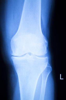 Diz eklem Menisküs x-ray sınama taraması