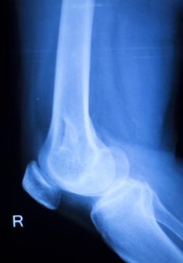 Diz eklem Menisküs x-ray sınama taraması