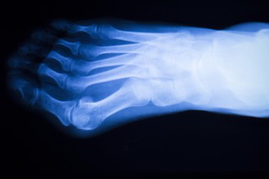 Ayak ve ayak parmakları yaralanma x-ray tarama