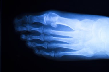 Ayak ve ayak parmakları yaralanma x-ray tarama