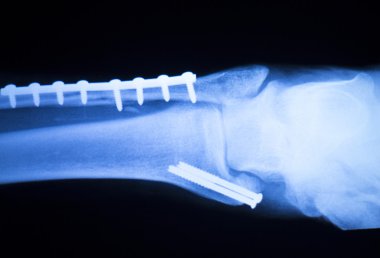 Foot ankle and shin xray scan clipart