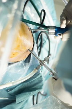 Diz artroskopisi ortopedik cerrahi operasyon