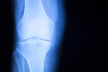 Diz eklem Menisküs x-ray sınama taraması