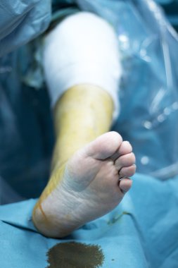 Diz artroskopisi ortopedik cerrahi operasyon