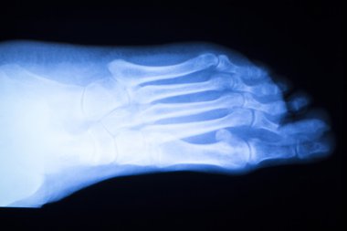 Ayak ve ayak parmakları yaralanma x-ray tarama