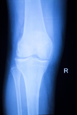 Diz eklem Menisküs x-ray sınama taraması