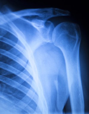 Omuz yaralanması ortopedi xray tarama