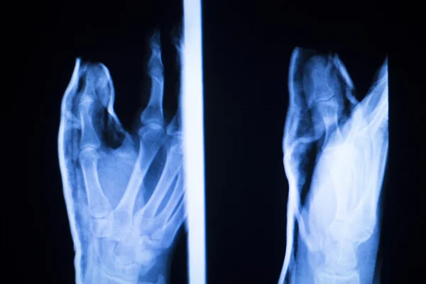 Пошкодження ніг і ніг рентгенівського сканування — стокове фото