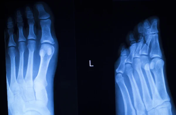 발과 발가락 부상 x 선 검사 — 스톡 사진
