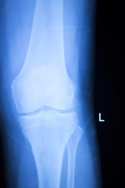 Examen de rayos X de menisco articular de rodilla —  Fotos de Stock