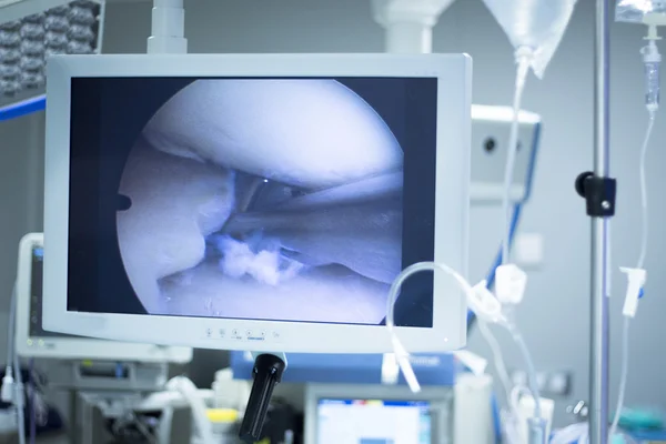 Hospital surgery arthroscopy operation screen — Stock Photo, Image