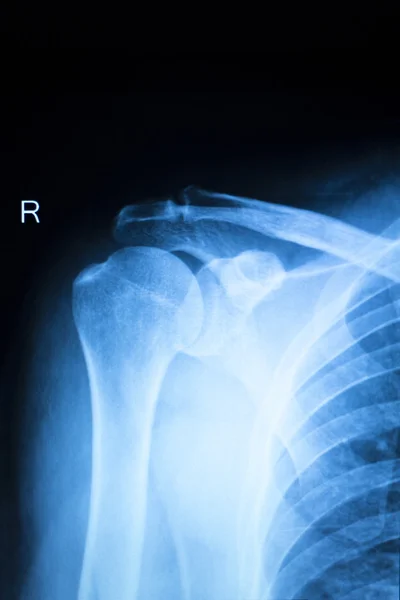 Schulterverletzung Orthopädie Röntgenbild — Stockfoto