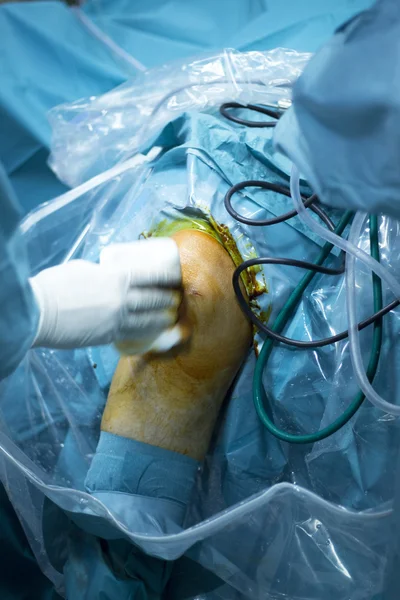 Artroscopia de joelho cirurgia ortopédica — Fotografia de Stock