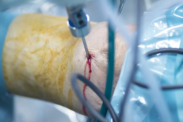 Orthopedic surgery meniscus operation