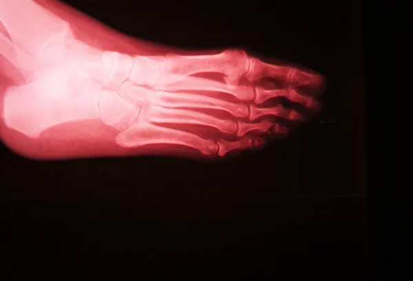 Ayak ve ayak parmakları yaralanma x-ray tarama — Stok fotoğraf