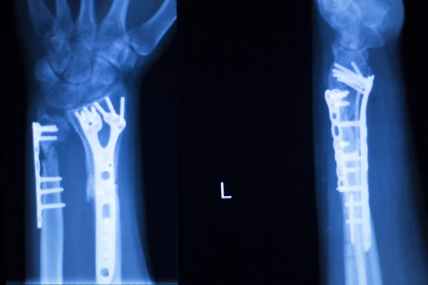 手骨科 x 线扫描 — 图库照片