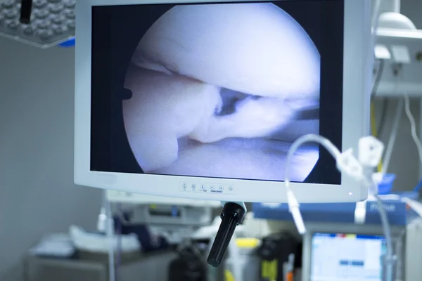 Cirugía hospitalaria artroscopia pantalla de operación —  Fotos de Stock