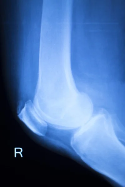 Kolenní společné meniskus x-ray test skenování — Stock fotografie