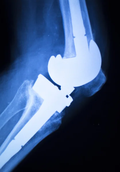 Teste de raio-x do implante articular do joelho — Fotografia de Stock
