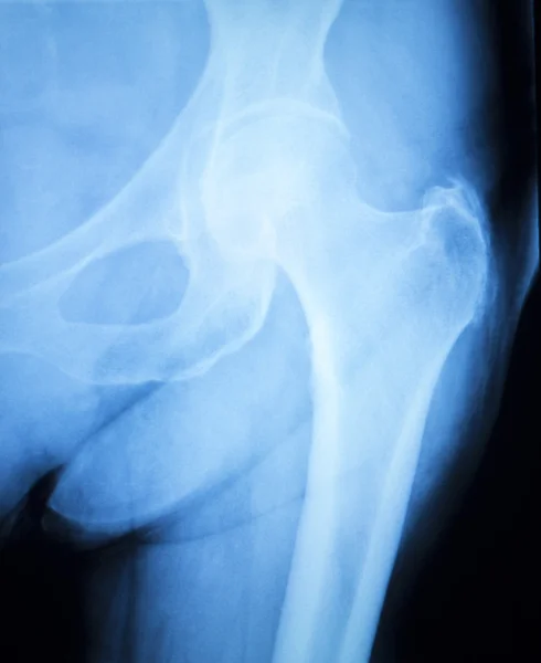 Výsledky kontroly artritidou kyčle xray — Stock fotografie