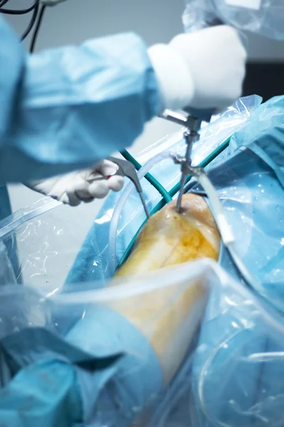 整形外科の膝関節鏡の手術 — ストック写真