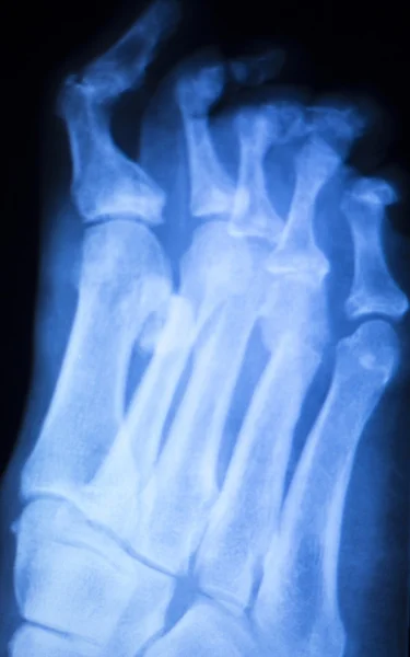 Lábfej és lábujjak kár röntgen vizsgálat — Stock Fotó