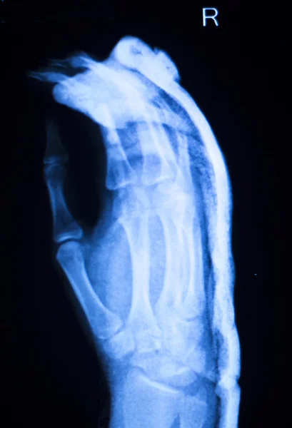 Escáner de rayos X del hospital del dedo pulgar de mano —  Fotos de Stock