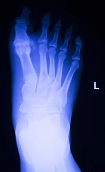 Foot and toes injury x-ray scan — Stock Photo, Image