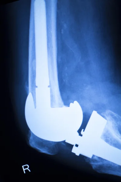 Knäleden implantat x-ray test scan — Stockfoto