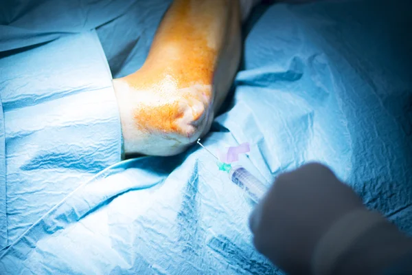 Operazione di chirurgia ortopedica del gomito dell'ospedale — Foto Stock