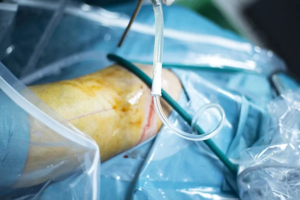 Artroskopia kolana chirurgii ortopedycznej operacji — Zdjęcie stockowe