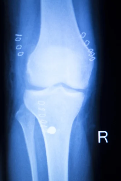 Examen de rayos X de menisco articular de rodilla — Foto de Stock