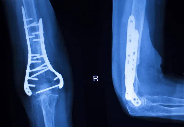 Exploración de rayos X del codo del brazo del implante quirúrgico — Foto de Stock