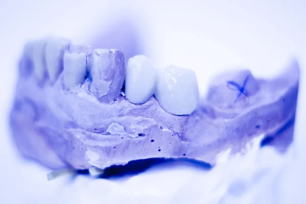 Zubní protézy jíl zub plíseň — Stock fotografie