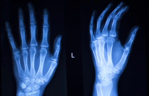 Escáner de rayos X del hospital del dedo pulgar de mano — Foto de Stock
