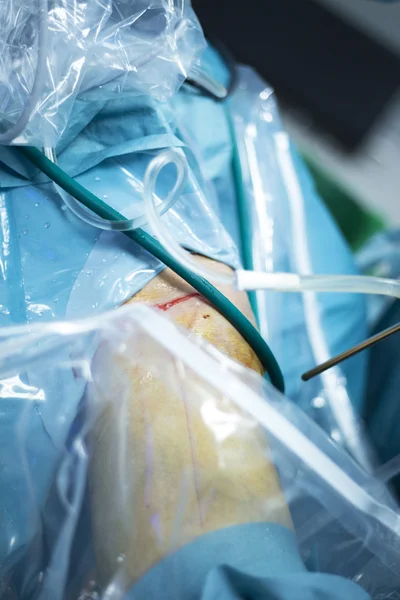 Artroscopia del ginocchio intervento di chirurgia ortopedica — Foto Stock