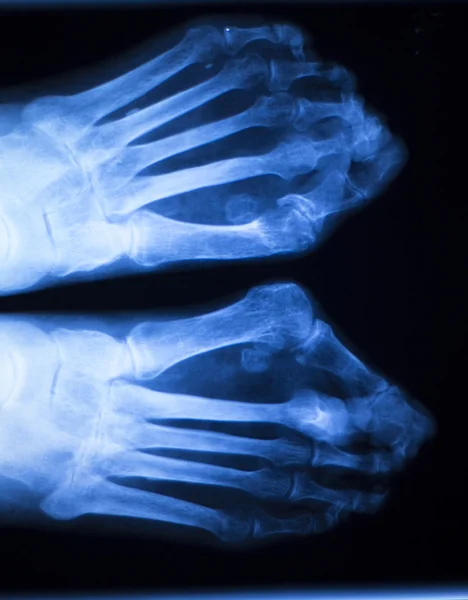 Foot and toes injury x-ray scan — Stock Photo, Image