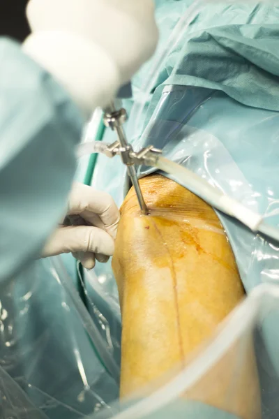 Knee arthroscopy orthopedic surgery operation — Stock Photo, Image