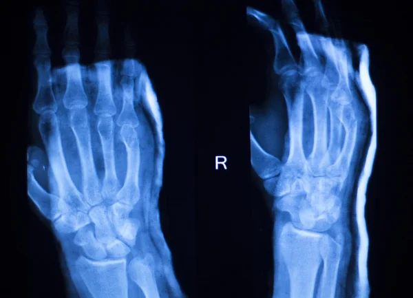 Hand finger thumb hospital xray scan — Stock Photo, Image
