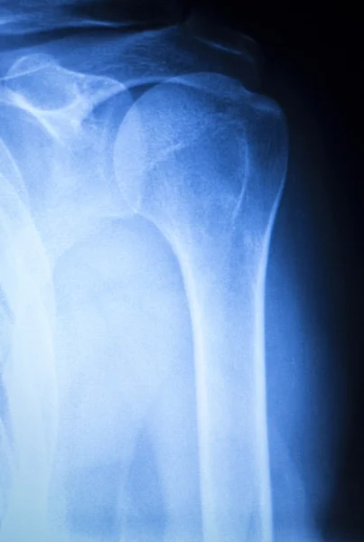 Lesión de hombro ortopedia escáner de rayos X — Foto de Stock